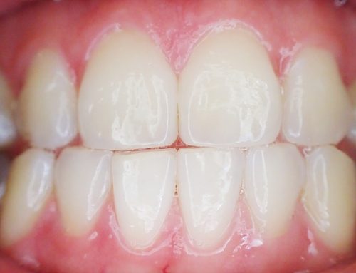 What is Gingivitis?