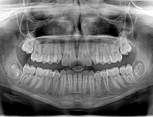 The Ultimate Cheat Sheet on Dental X-Rays