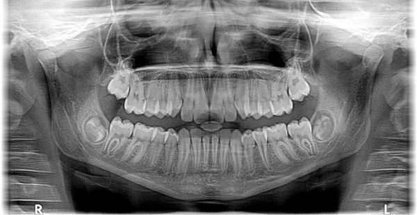 The Ultimate Cheat Sheet on Dental X-Rays - Baldwin Family Dental