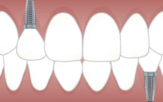 Dental implants hold replacement teeth in place after injury.