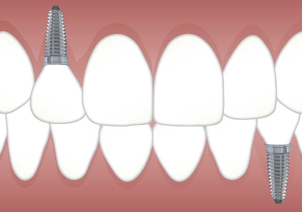 Dental implants hold replacement teeth in place after injury.