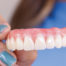 Dentures replace natural teeth with artificial teeth to improve smile and restore ability to chew, speak and bite properly.
