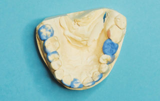 Partial dentures are a combination of your natural teeth and synthetic teeth.
