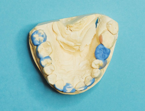 What are Partial Dentures?