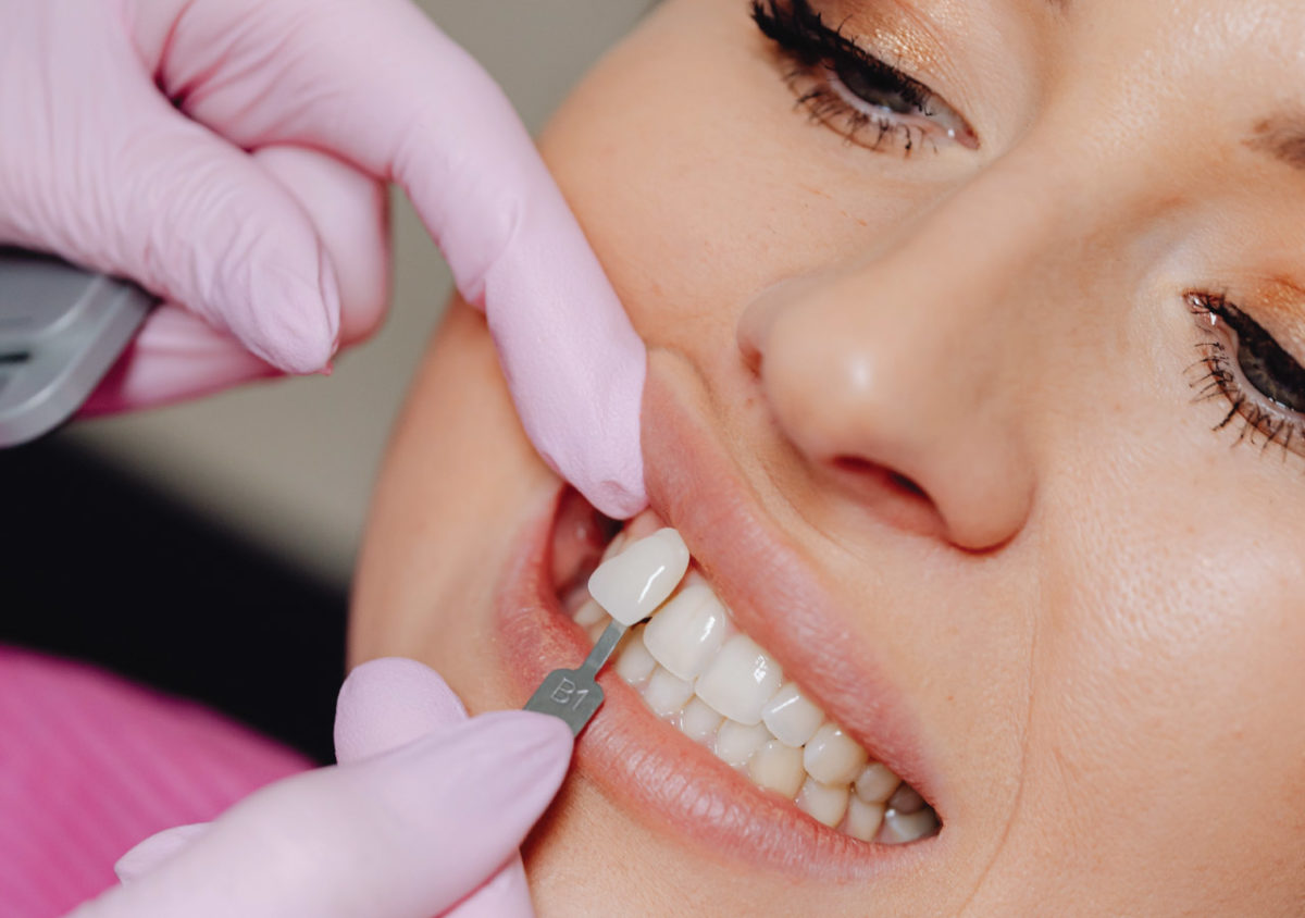 What is a Dental Crown? Baldwin Family Dental