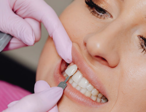 What is a Dental Crown?